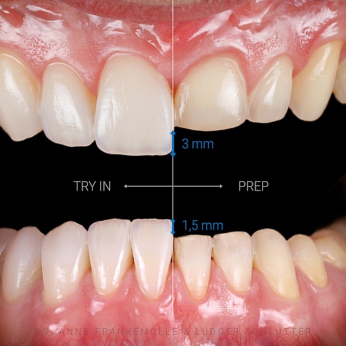 Minimal invasive Veneers / Veneerlays in the upper and lower jaw with bite elevation. . . Dentist: @annefrankemolle ...