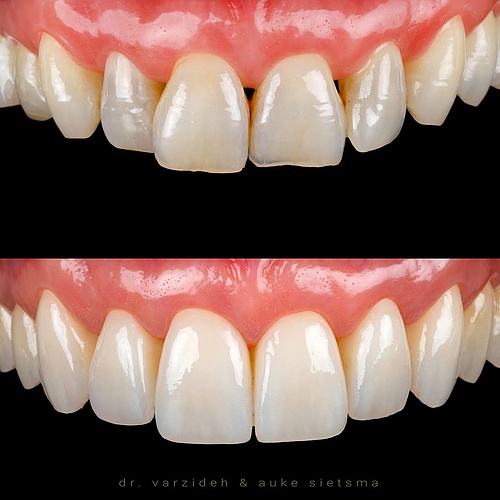 Dental veneers and crowns . . Dentist: @dr.varzideh Dental Technician: @aukesietsma . . 📸: @eden_dental_photography ....