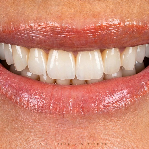 Full renovation with 26 partial dental crowns! In combination with a bite lift for a full natural smile. �. . Dentist:...