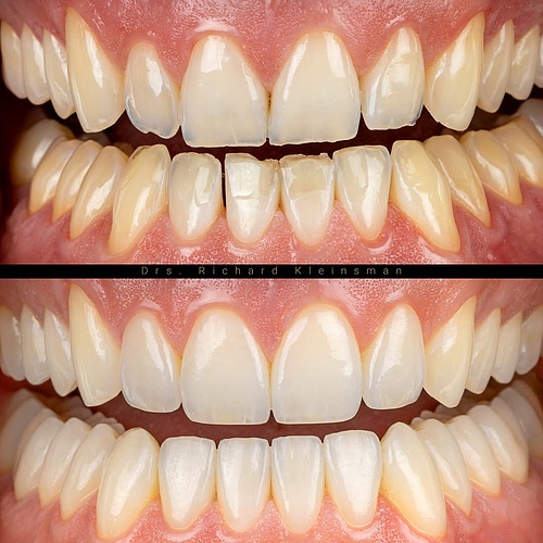 Full lower jaw restoration with non-prep veneers and facelays after years of grinding; �In the upper jaw, I also placed...