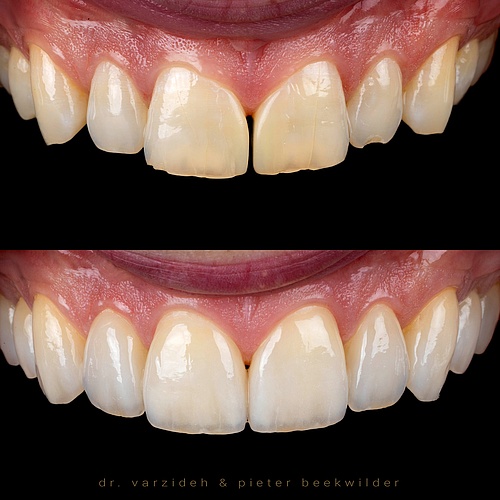 The natural look. No fake white teeth, but invisible veneers without drilling or doing any harm to your teeth… . ....