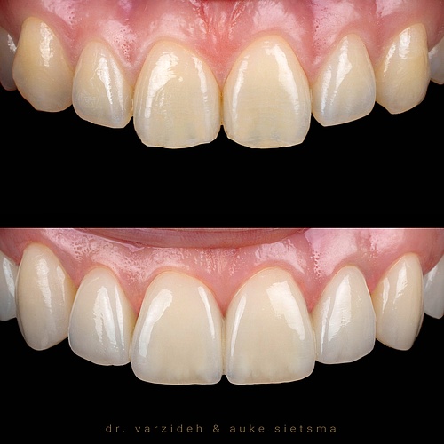 Imagine what it could do for you! If you're considering a smile makeover, non-prep veneers might be the perfect...