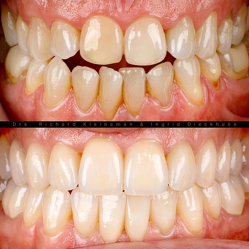 Full renovation of the upper and lower jaw (0.4 mm thick veneers), combined with a bite lift to close the open bite and...