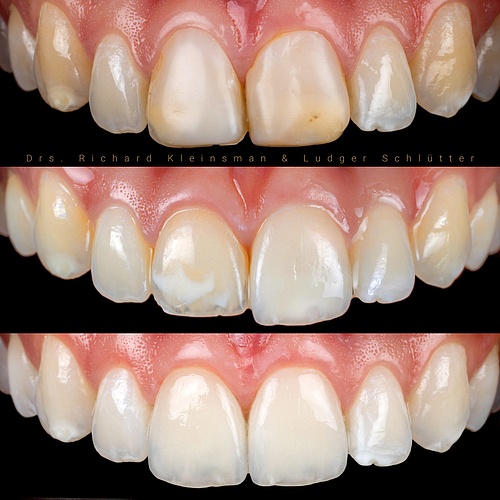 Removed old composite from both front teeth. Two very thin handmade veneers to cover the white spots and achieve better...