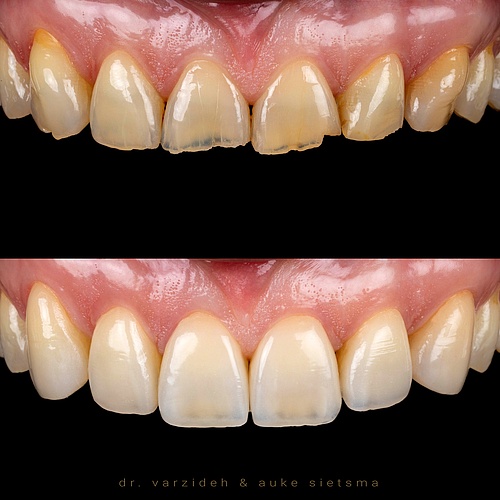 After years of grinding and erosive damage we were able to manage the situation with non prep veneers… . . Dentist:...