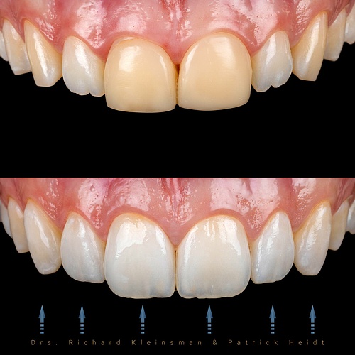 We've combined two crowns with four non-prep veneers to create a stunning, natural-looking smile. Slide to see the...