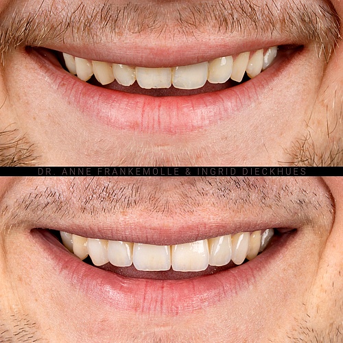 Harmonious and more masculine result by adjusting the length, colour and shape of the front teeth and optimizing the...