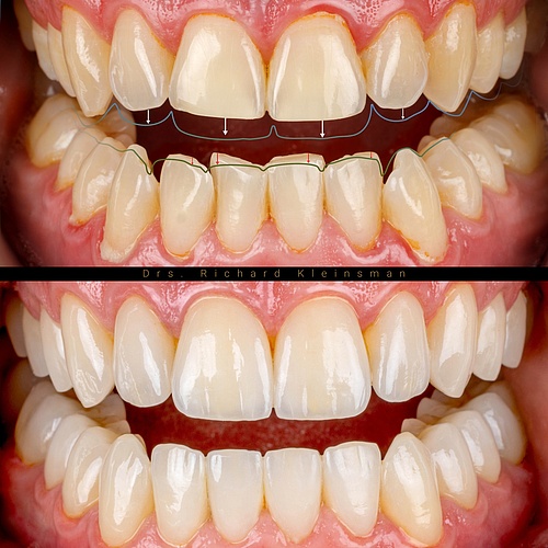 Total renovation of the upper and lower jaw with a bite lift! 12 veneers (minimal preparation), removing only the bulky...