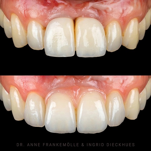 Who says pink aesthetics don’t matter? This case highlights just how crucial the color, contour, and zenith of the gums...