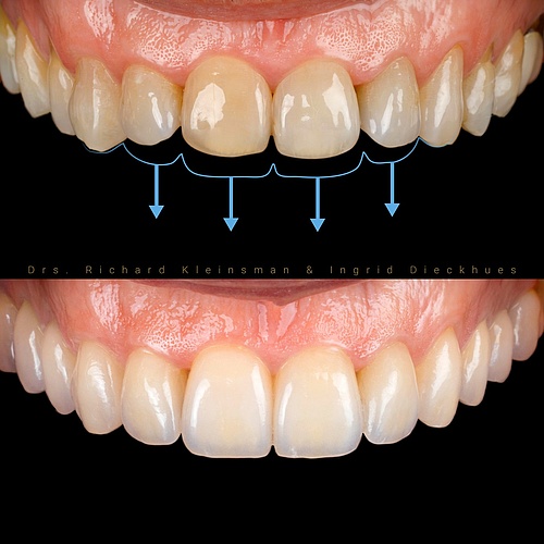 Complete renovation of the upper and lower jaw with 0.4 mm thin veneers, combined with a bite lift to close the open...