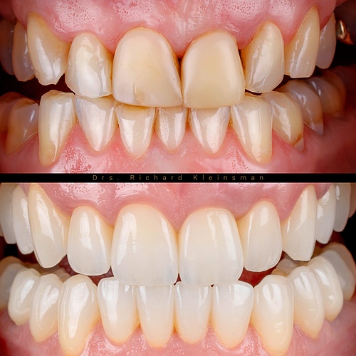 Full renovation with 26 partial crowns! . . Dentist: @drs.richardkleinsman Technician: @mike_richterbl . . 📸:...