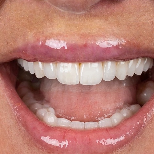 The Art of a Smile! #veneers #dentalveneers